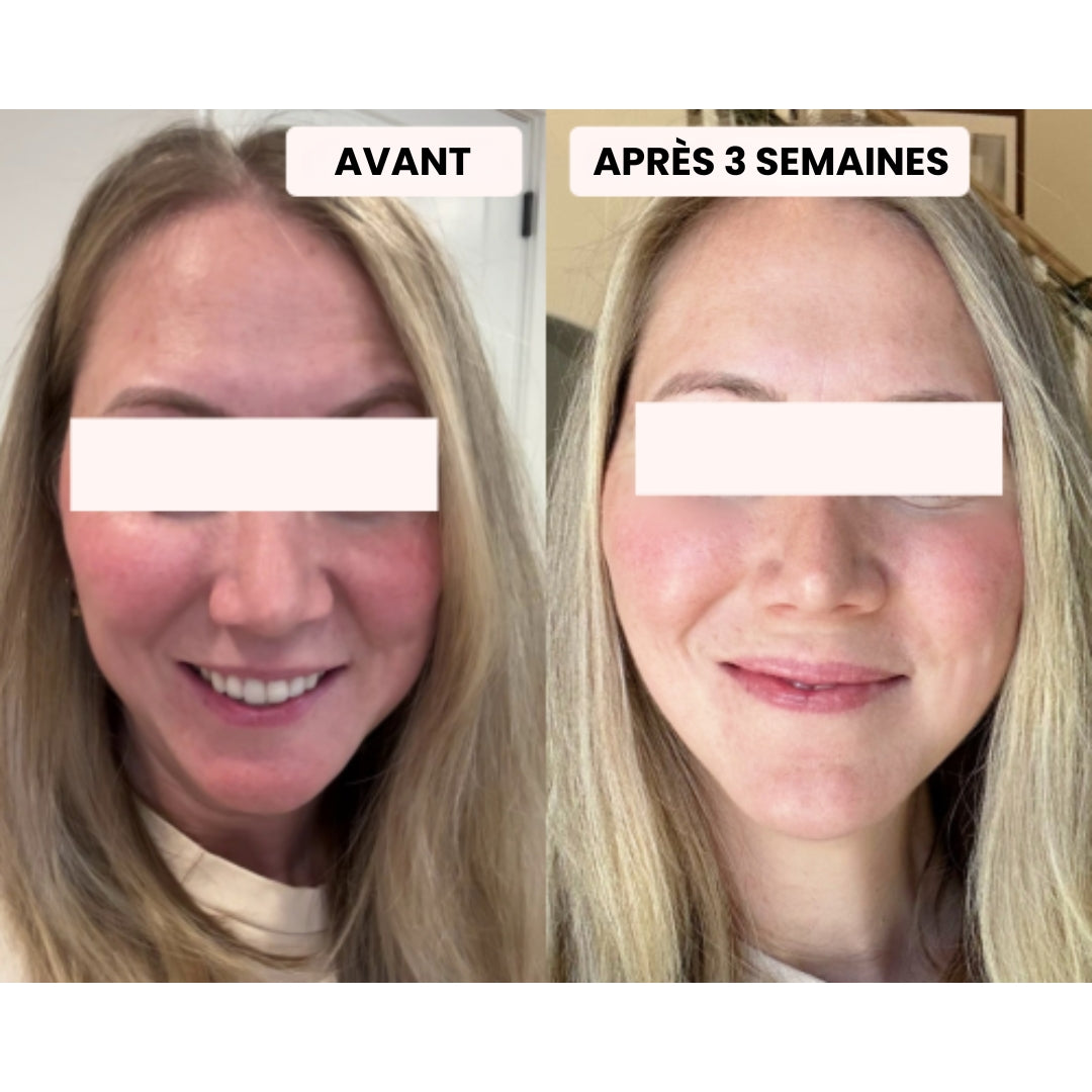 Masque LED - Dermalight X7