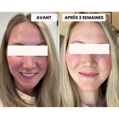 Masque LED - Dermalight X7